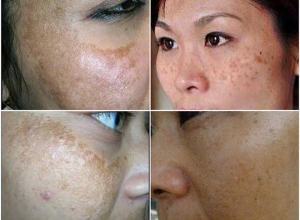 Tất tần tật về bệnh nám da nguyên nhân và cách chữa trị hiệu quả